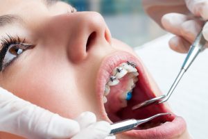 tipos de aparelhos ortodonticos 